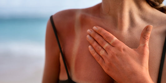 Sonnenallergie und juckende Hautrötungen am Strand lindern